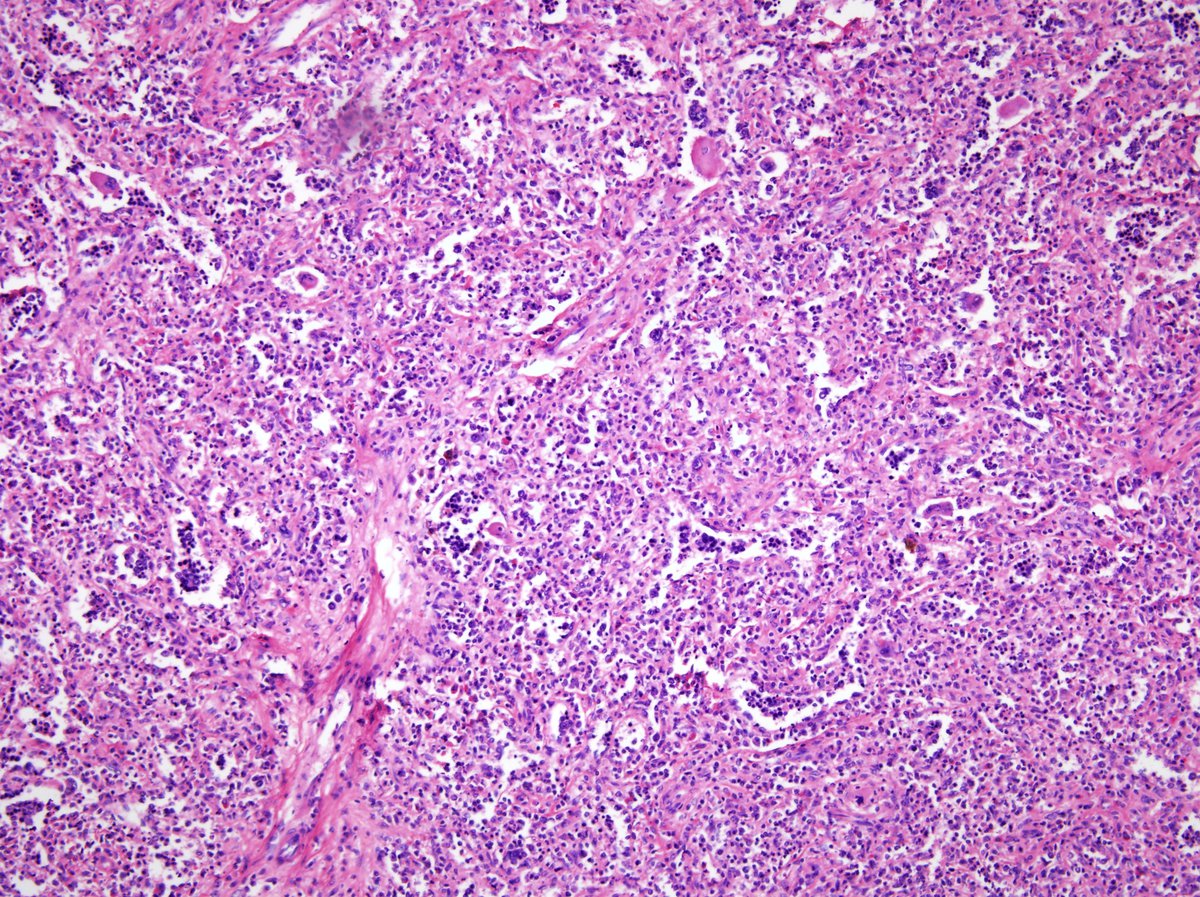 Low power view of spleen showing extensive extramedullary hematopoiesis